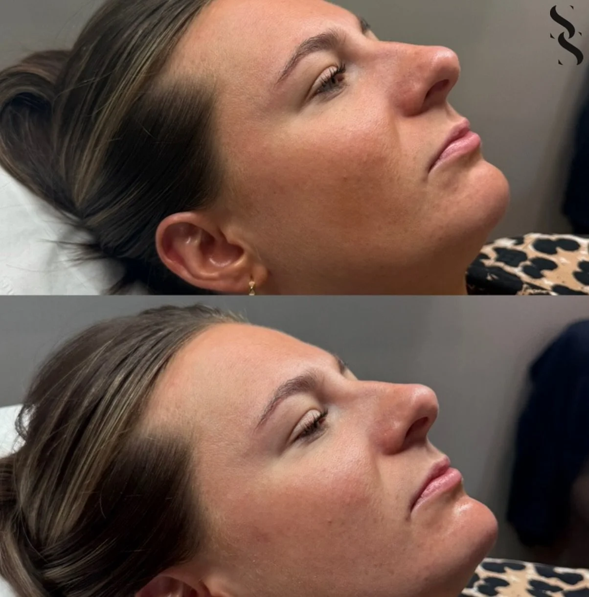 ~ C H I N  A U G M E N T A T I O N ~

A very subtle tweet here using @kairax_uk filler to enhance the lower face and create a more balanced profile 

Sculpt | Define | Balance. 💉

If you are looking to enhance your side profile then chin filler migh