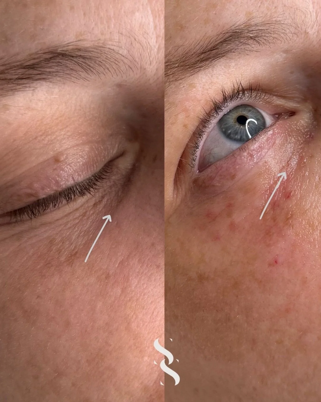 ~ I L L U M A  L U N A ~

Amazing result from just one session of illuma Luna eyes&hellip; 

Strategically placed to help naturally revive underneath tired eyes. With dark spot control it leaves a refreshed appearance to tired looking skin ✨

Get you