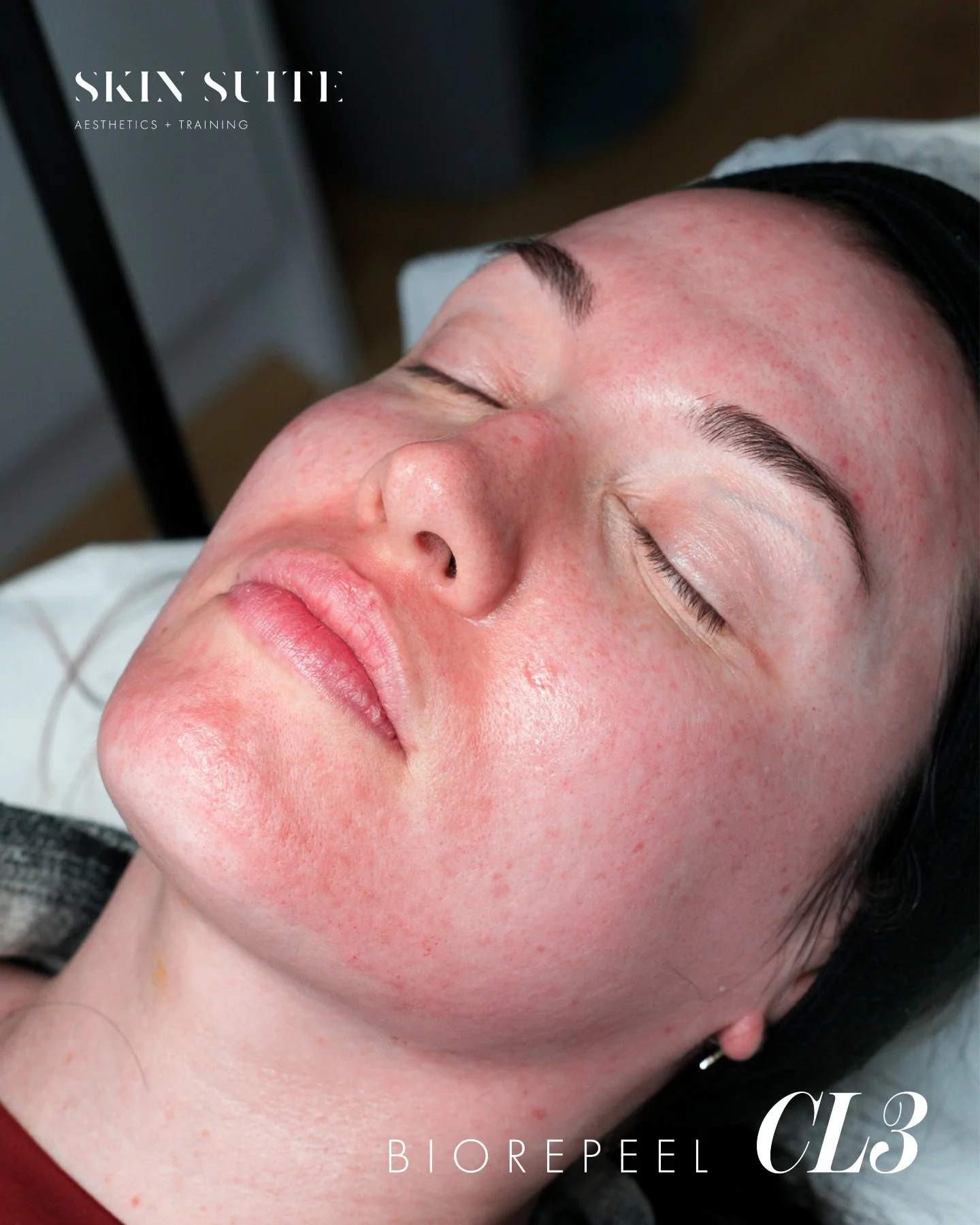 ✨ Harness the Power of BioRePeel CL3 ✨

BioRePeel CL3 is one of our most in-demand treatments for clients who want smoother, brighter, revitalised skin without the downtime of a traditional medium peel.

This innovative biphasic peel works from the i