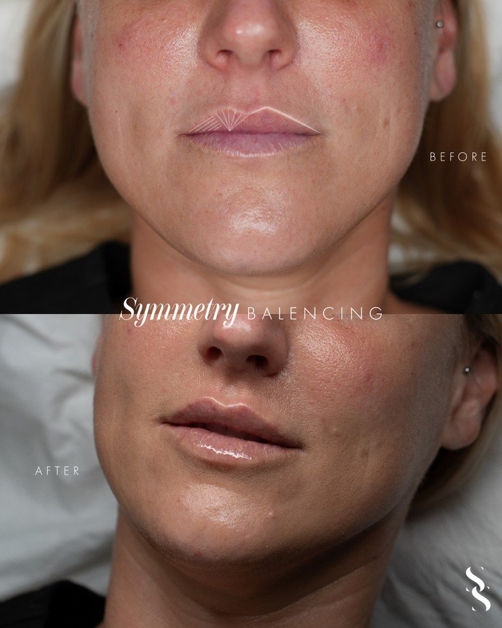 Sometimes, it&rsquo;s the smallest adjustments that make the biggest difference 🤍

This was a minimal lip filler top-up, focused on restoring symmetry and balance by gently enhancing the left side of the top lip.

No extra volume.
No overfilling.
Ju