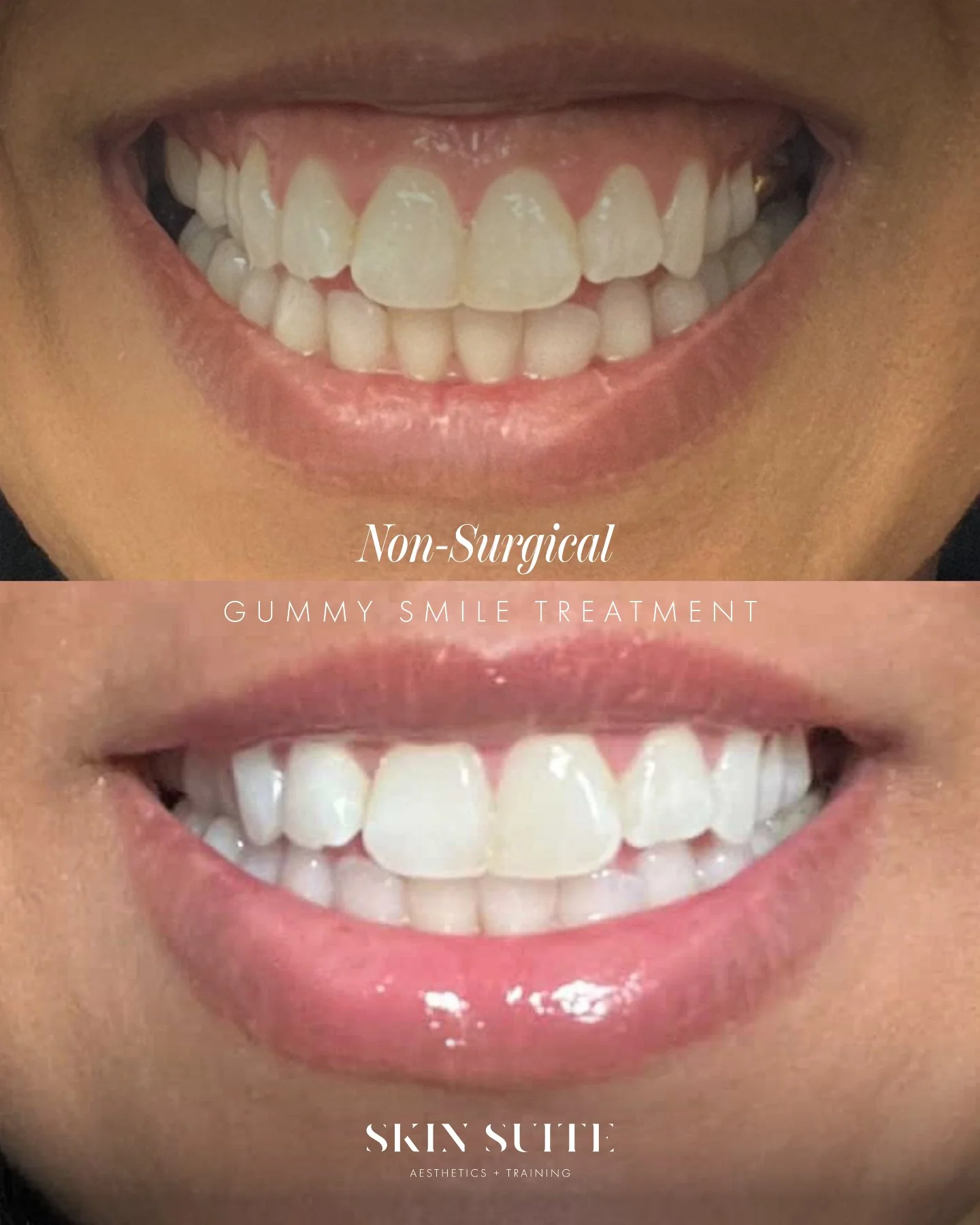 ✨ Gummy Smile Correction Results ✨

A gummy smile occurs when the upper lip lifts too high when smiling, exposing more gum than desired. For many clients, this can affect confidence even when the teeth and smile are otherwise healthy.

This treatment
