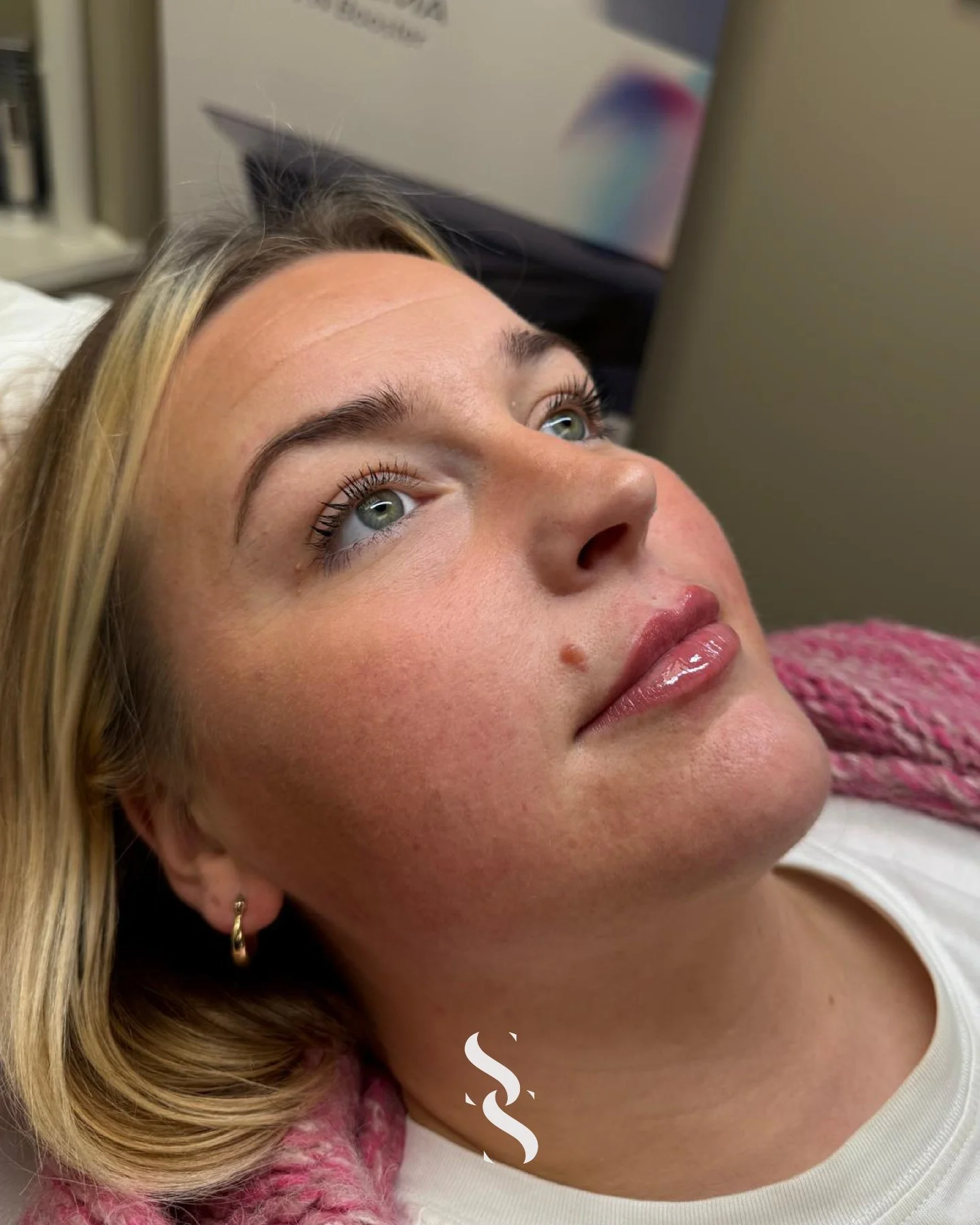 ~ L I P  E N H A N C E M E N T ~

✨ Soft, natural lip enhancement ✨

This transformation is all about subtle volume, improved shape and balance &mdash; enhancing the lips while keeping them natural, hydrated and in harmony with the rest of the face.
