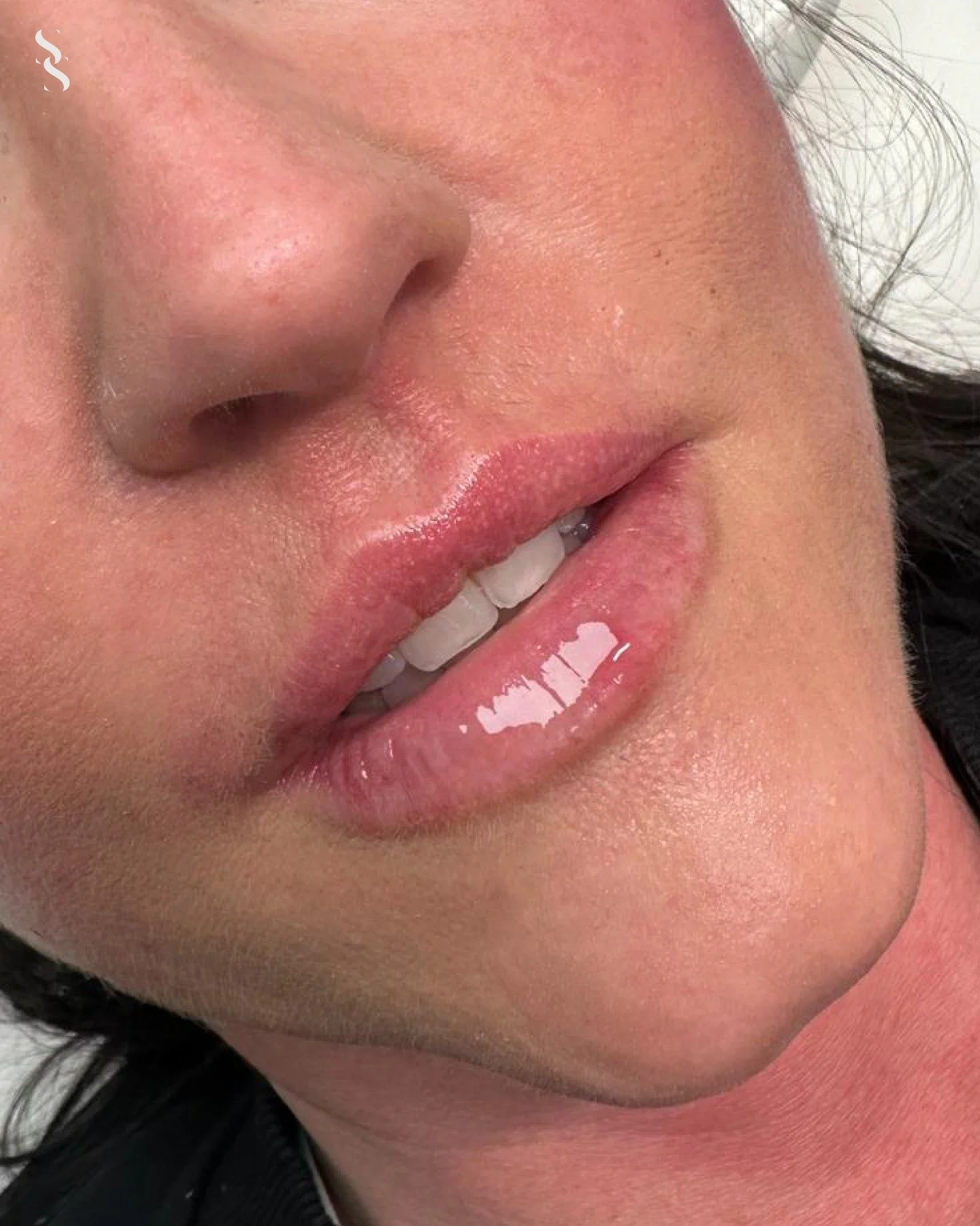 💋 ~ A  M O N T H  O F  L I P  A U G M E N T A T I O N ~

✨ A look back at a month of beautifully balanced lip results ✨

Every set of lips is unique, which is why each treatment is tailored to enhance shape, restore balance and maintain a soft, natu