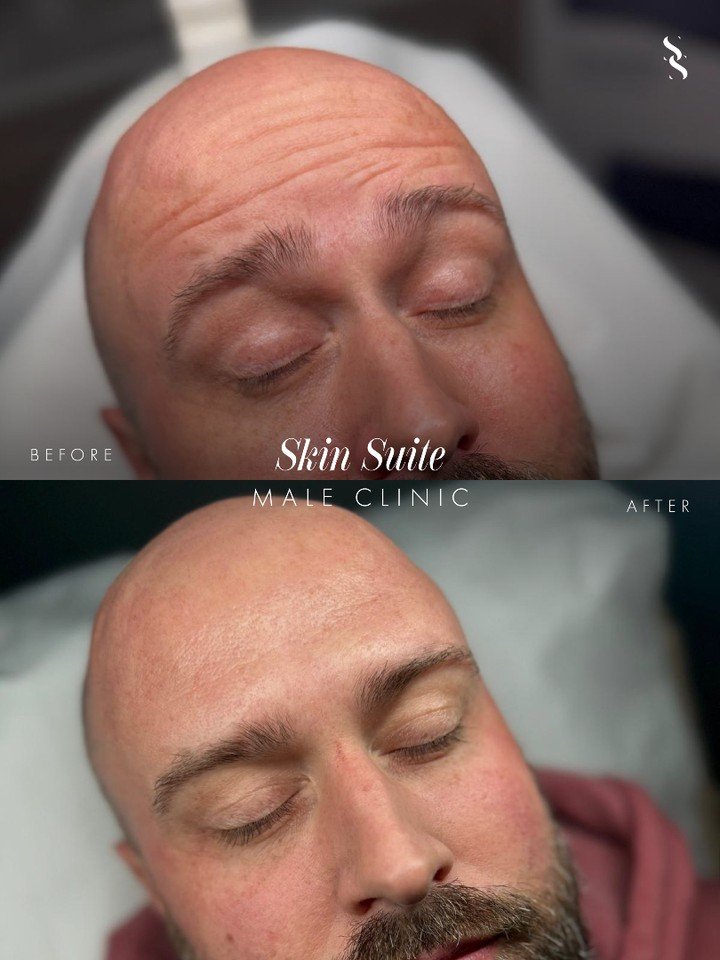 ~ S K I N  S U I T E  M A L E  C L I N I C ~

Subtle results. Natural confidence.

This transformation focuses on softening visible lines while maintaining natural movement and expression, helping the skin look fresher, smoother and more rested.

Mor