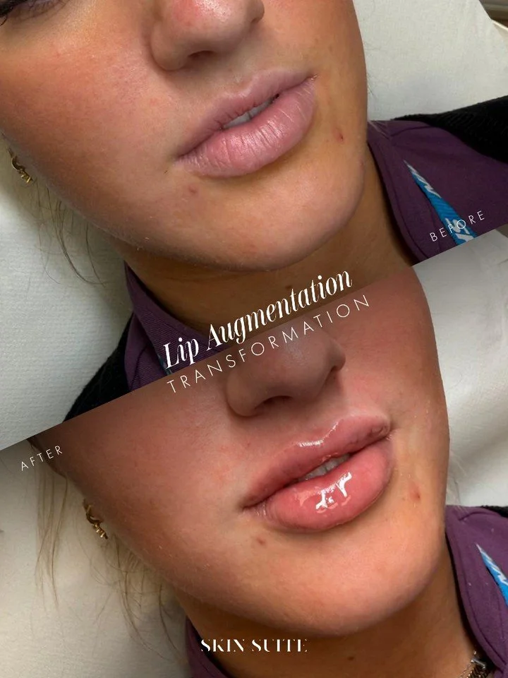 ~ L I P  A U G M E N T A T I O N ~

Subtle changes can make a beautiful difference.

This treatment focused on enhancing the natural lip shape while maintaining softness and balance with the rest of the face.

The goal was to create:

💋 Improved lip