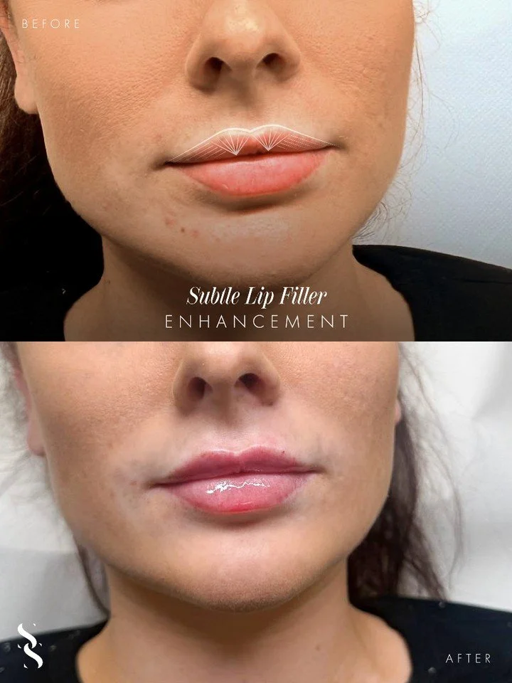 ~ S U B T L E  L I P  E N H A N C E M E N T S ~

Less volume, more refinement 💋

This treatment focuses on enhancing what&rsquo;s already there. Creating a softer, more balanced lip shape without overfilling.

Think small adjustments that make a not