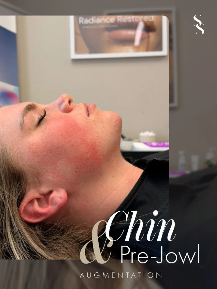 ~ F A C I A L  B A L A N C I N G ~

Subtle structure. Noticeable difference. ✨

This transformation focused on enhancing the lower face to improve overall balance and profile.

Treatment carried out:
💉 1.5ml Chin
💉 0.5ml Pre-jowl

By adding project