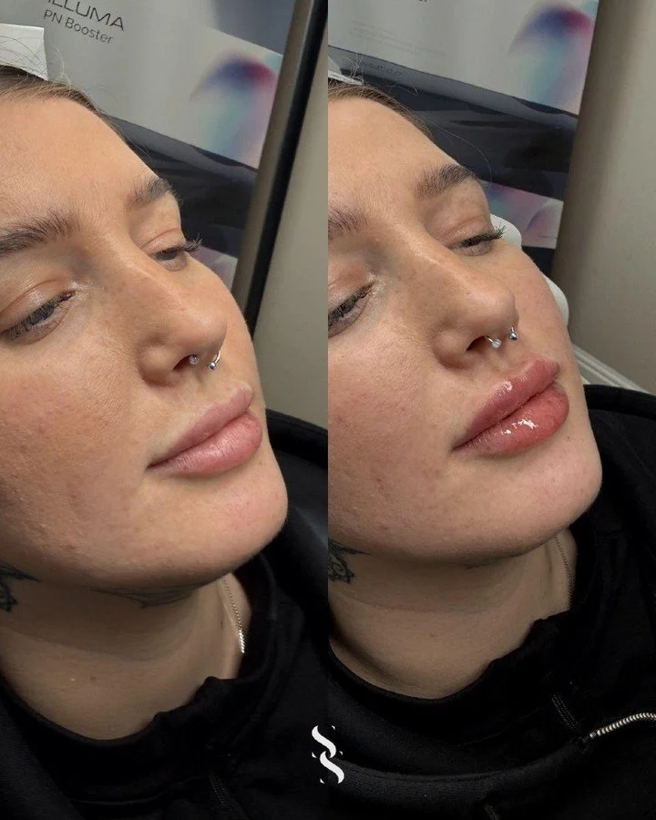 ~ S U B T L E  E N H A N C E M E N T S ~

A soft refresh, not a dramatic change 💋

This treatment focused on enhancing the natural lip shape, adding gentle volume, improving hydration and refining the overall finish.

The difference is in the detail