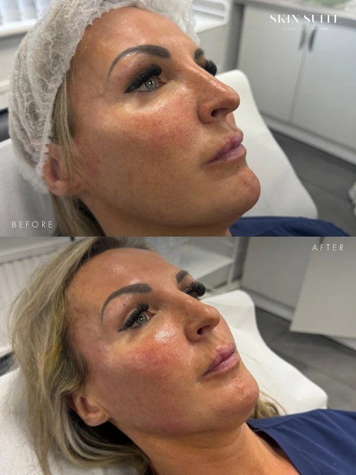 ✨ Progressive, collagen-led rejuvenation ✨

These results were achieved following just one Sculptra PLLA treatment, designed to gradually improve skin structure, firmness and overall facial quality over time.

Unlike traditional volumising treatments