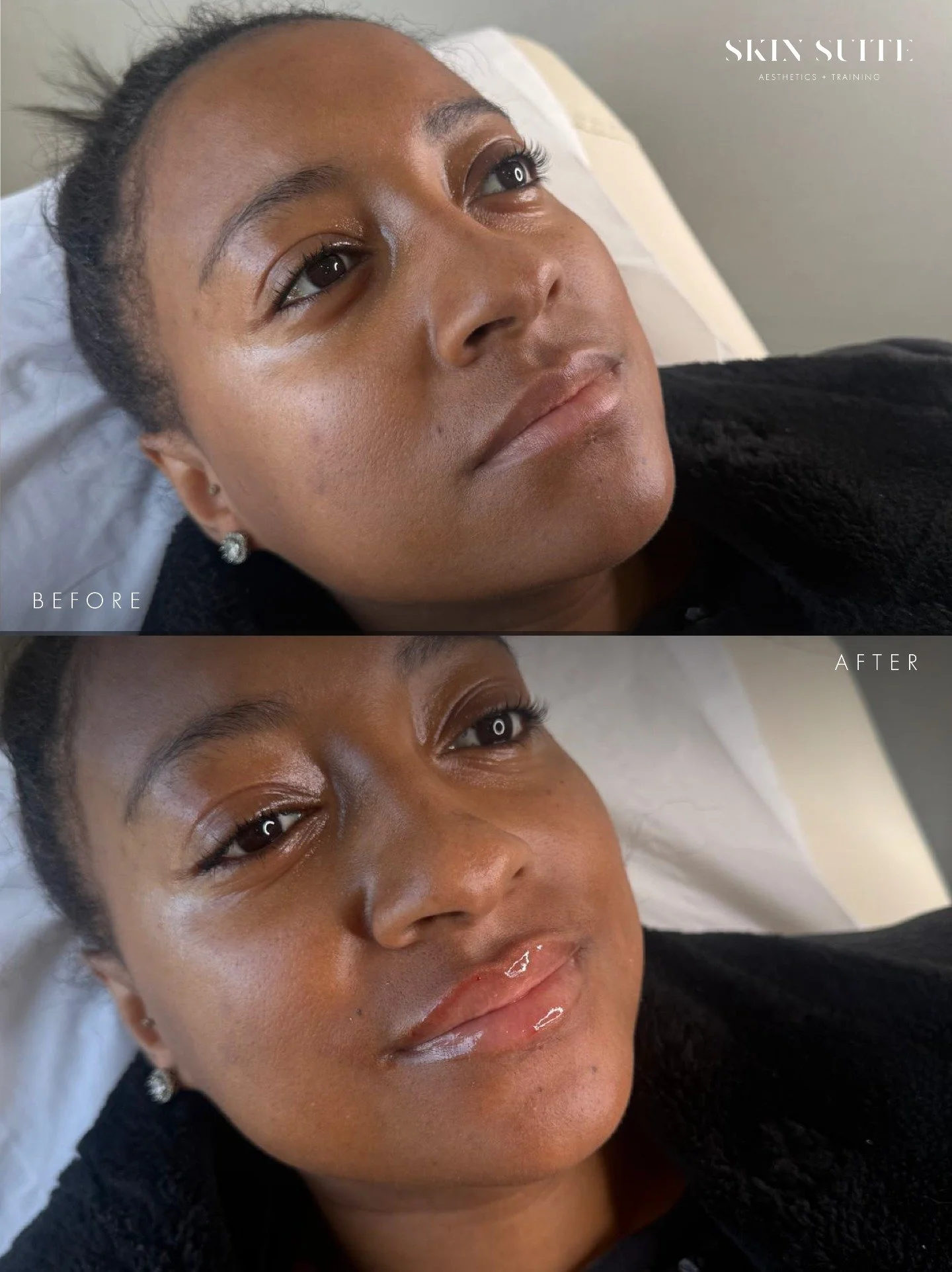 ~ L I P T R A N S F O R M A T I O N ~

Soft volume. Refined shape. Natural balance 💋

This treatment focused on enhancing the natural lip shape while maintaining softness and proportion.

Every lip treatment is tailored to the individual, creating r