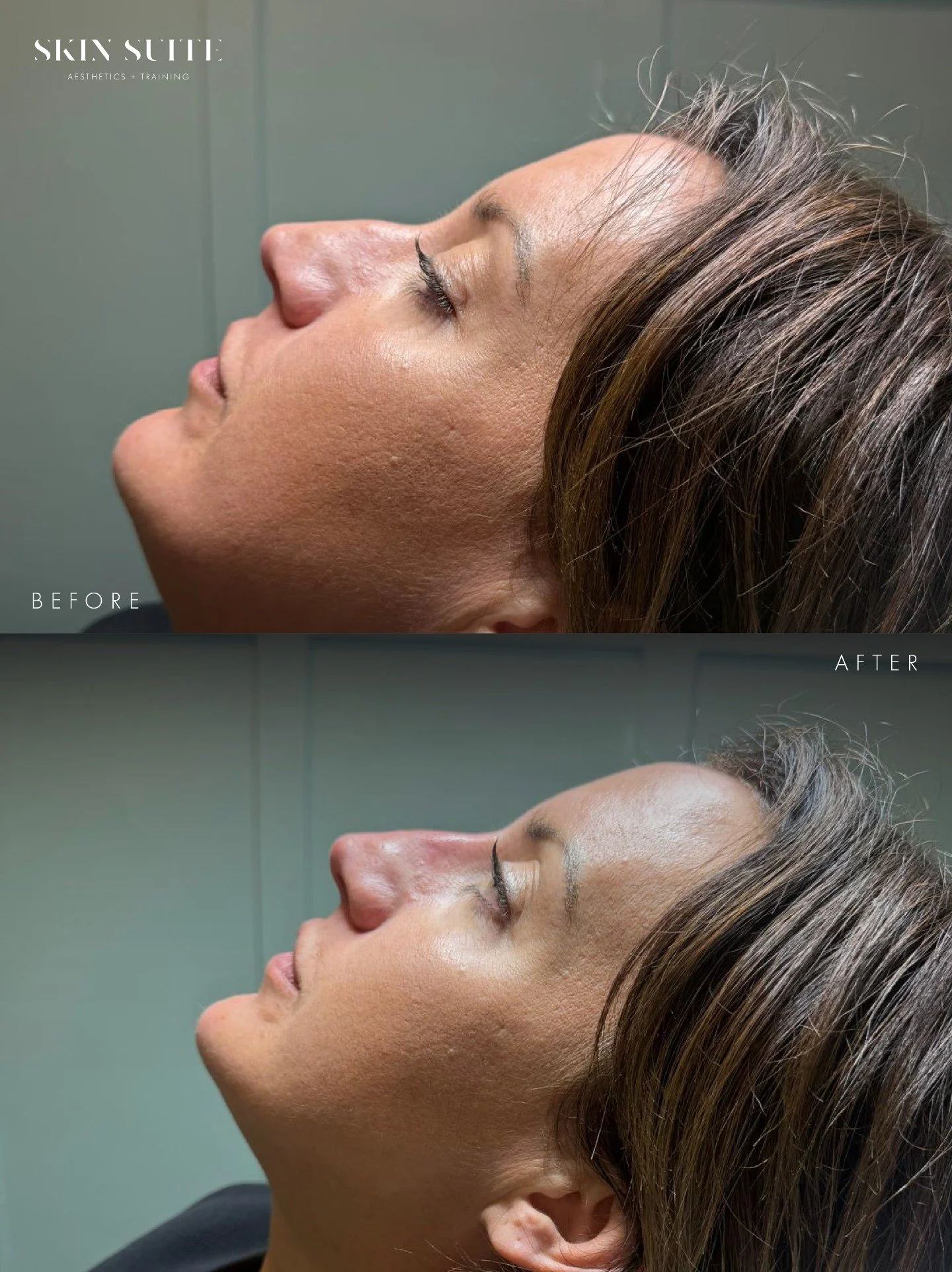 ~ N O N - S U R G I C A L - N O S E - A U G M E N T A T I O N ~

Subtle refinement can completely transform facial balance ✨

This treatment focused on smoothing and refining the profile while maintaining natural proportions and harmony with the rest