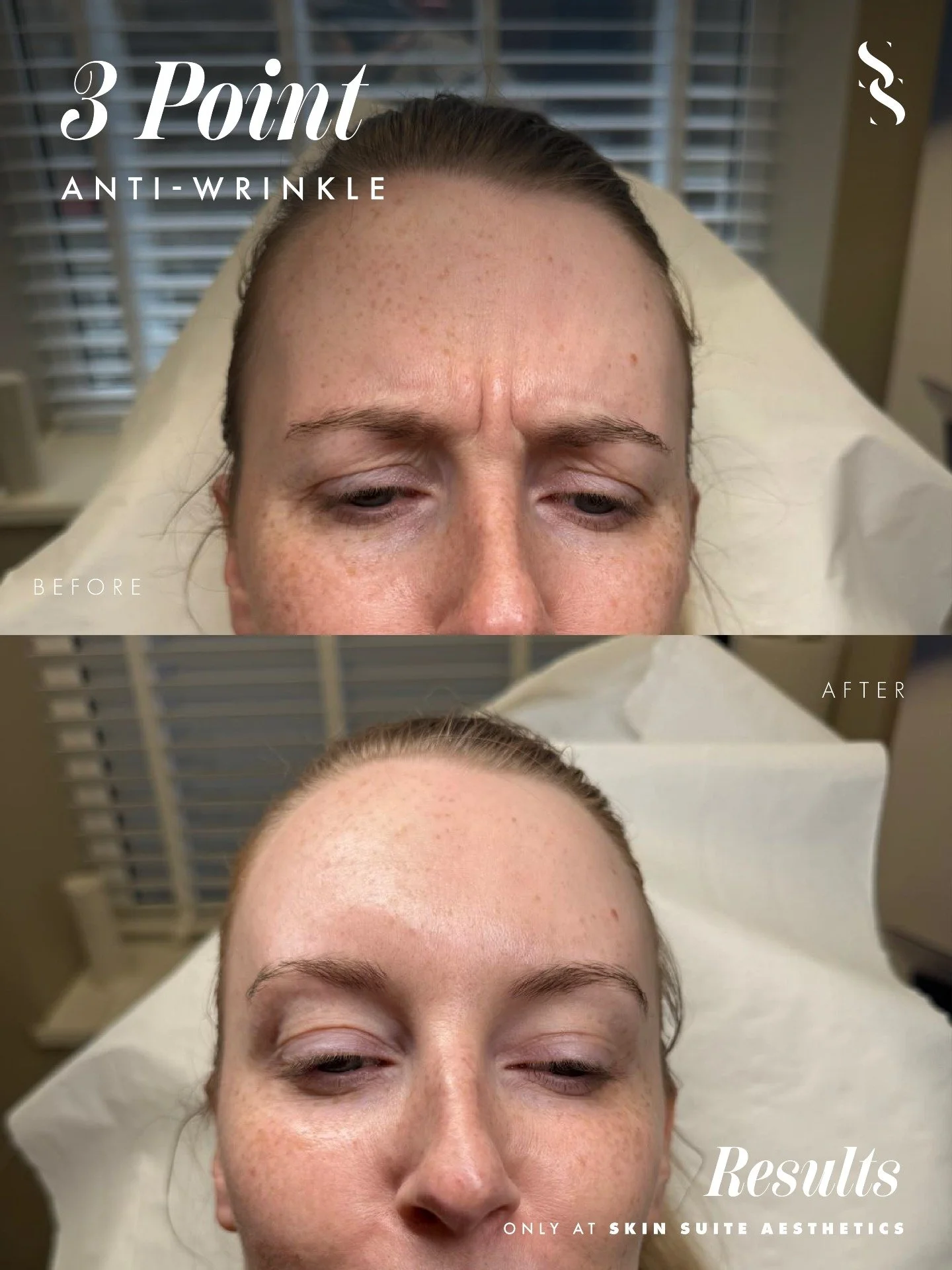 ✨ A subtle refresh can make all the difference ✨

A personalised treatment plan designed to soften the appearance of upper facial lines while maintaining natural expression and movement.

The goal is never to look different, it's to look like a fresh