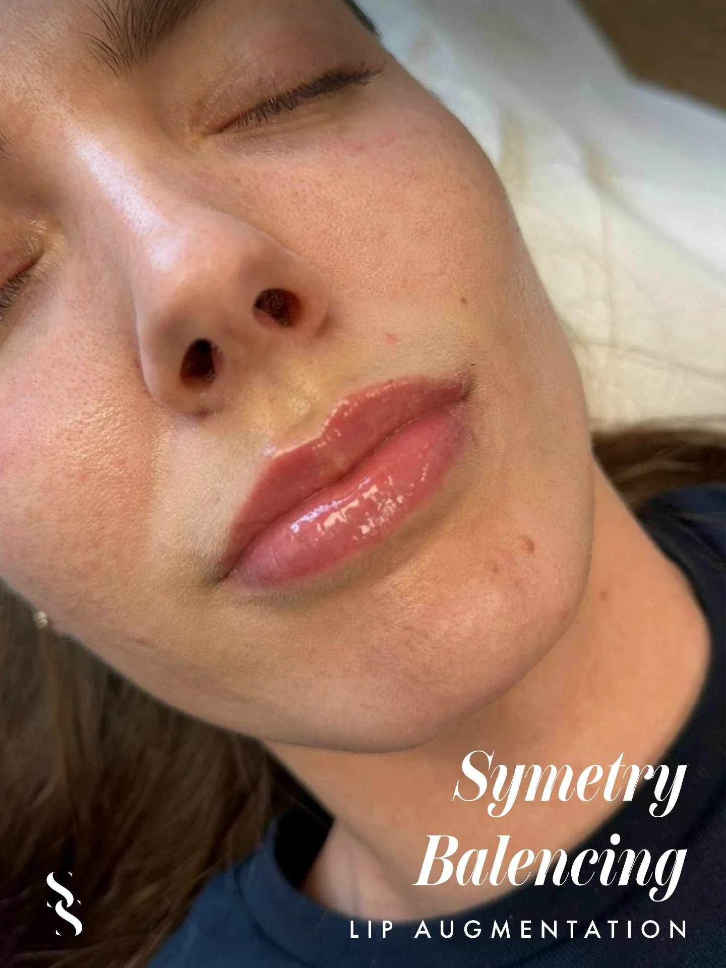 💋 Lip Top-Up Results

Not every lip appointment is about adding more volume.

Sometimes the most impactful results come from the smallest refinements, restoring balance, improving symmetry and maintaining shape as previous treatments naturally settl