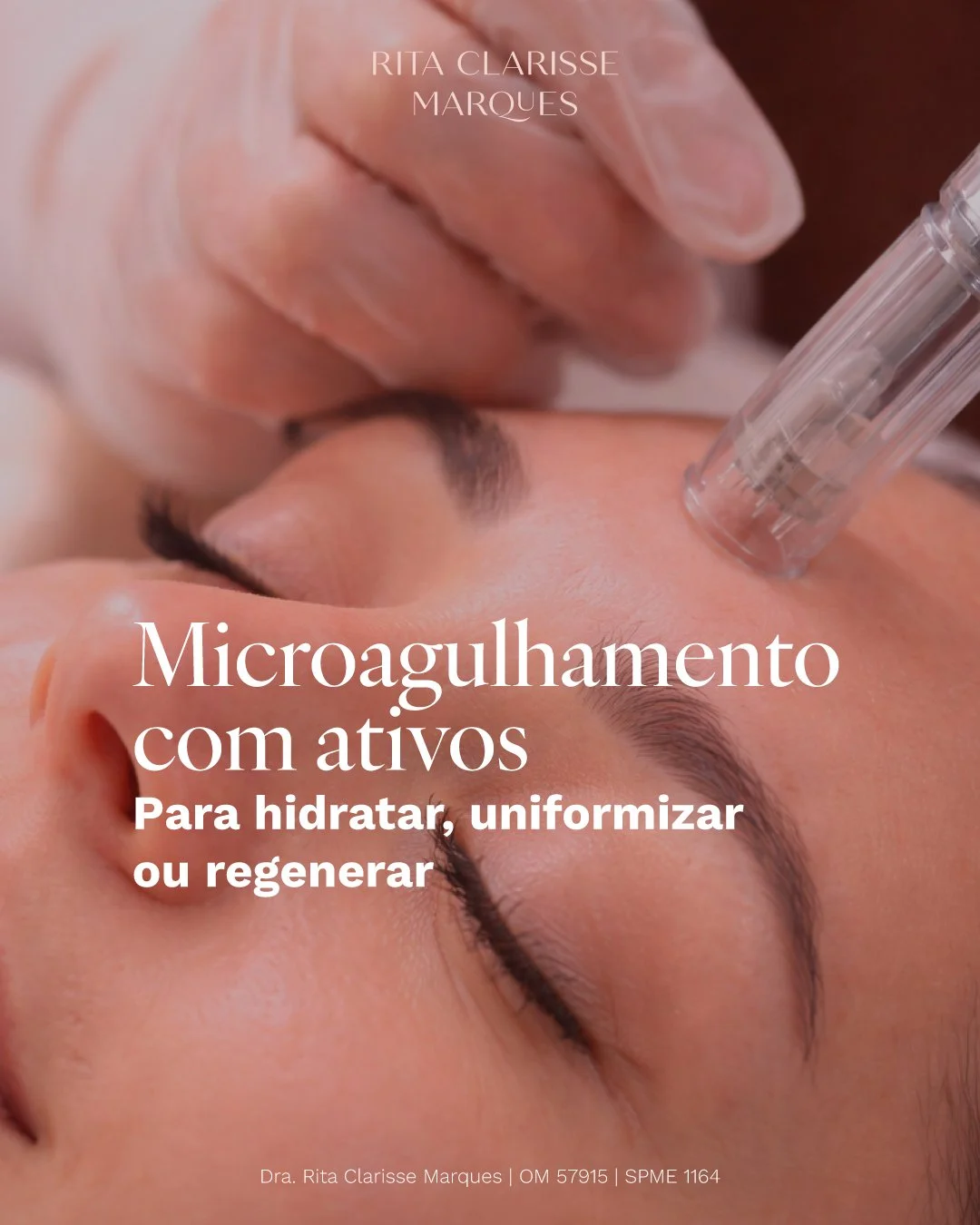 O microagulhamento torna-se ainda mais eficaz quando &eacute; adaptado &agrave;s necessidades reais da pele.

A escolha dos ativos certos faz toda a diferen&ccedil;a nos resultados, seja para hidratar, uniformizar, regenerar ou refor&ccedil;ar a firm