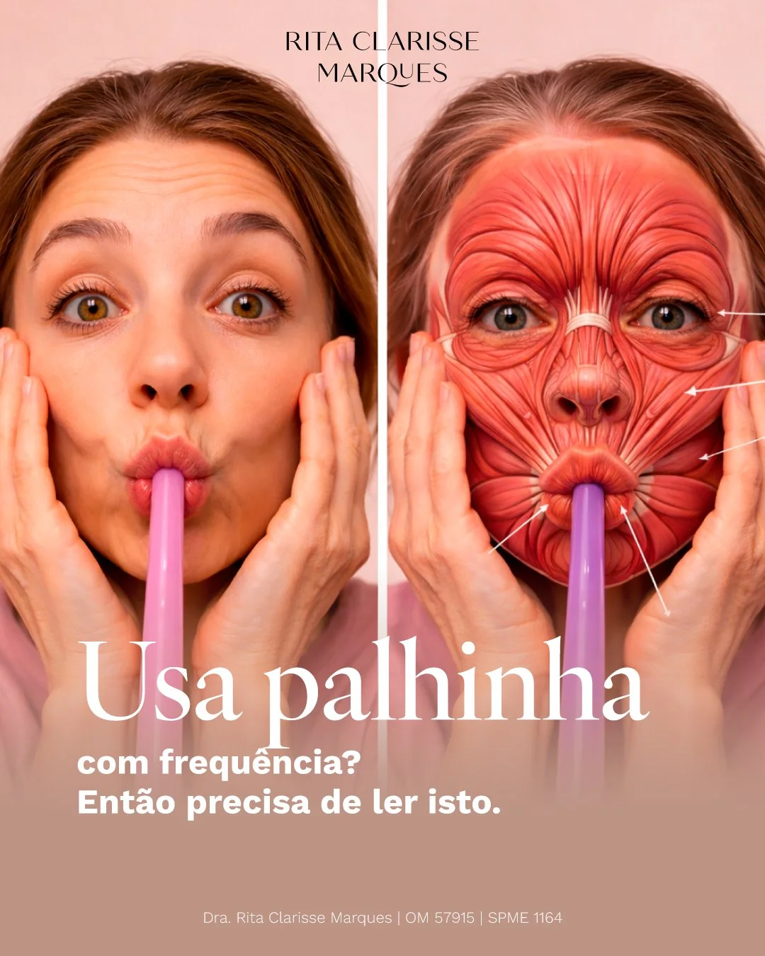 Sabia que a repeti&ccedil;&atilde;o do movimento ao usar palhinha pode contribuir para o aparecimento de linhas &agrave; volta da boca ao longo do tempo?

Este gesto ativa constantemente o m&uacute;sculo orbicular dos l&aacute;bios, o mesmo envolvido