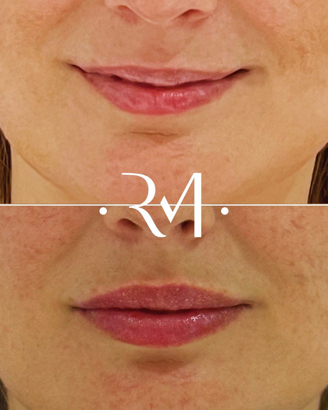 L&aacute;bios mais hidratados, definidos e naturais. 💋✨

Partilhe comigo nos coment&aacute;rios, o que gostaria de melhorar nos seus l&aacute;bios?

Dra. Rita Clarisse Marques
OM 57915 | SPME 1164

#preenchimentolabial #labios #acidohialuronico #lab