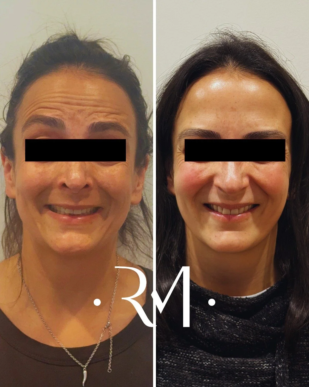Suaviza&ccedil;&atilde;o das linhas de express&atilde;o, mantendo a naturalidade do olhar.

Resultando numa apar&ecirc;ncia mais leve e descansada, sem perder a express&atilde;o nem a identidade. ✨

Quer suavizar a express&atilde;o mantendo a natural
