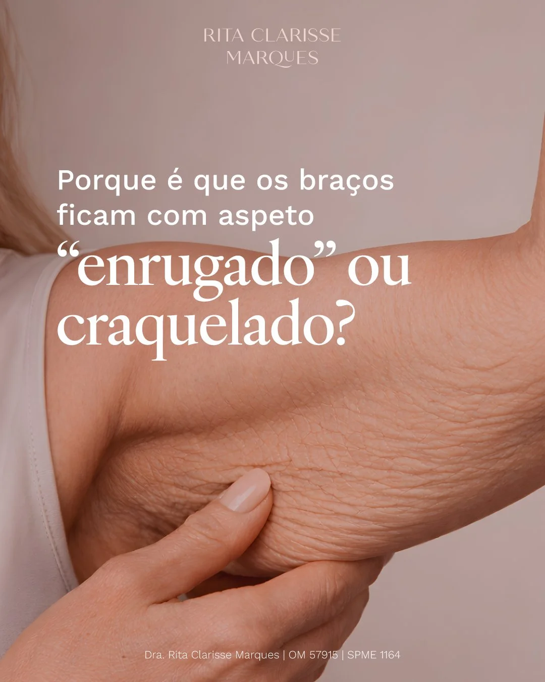 A flacidez nos bra&ccedil;os &eacute; uma das altera&ccedil;&otilde;es mais comuns com o passar do tempo, mas muitas vezes s&oacute; &eacute; valorizada quando j&aacute; est&aacute; mais avan&ccedil;ada.

Olhar para estes sinais de forma precoce perm
