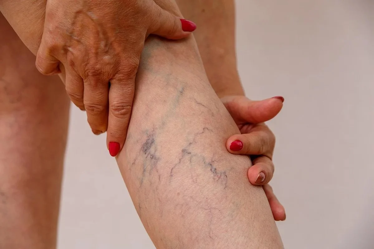 A person with red nail polish holding their leg, which has prominent blue and purple varicose veins.