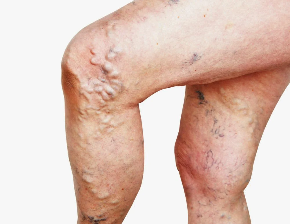 Close-up view of leg with bulging varicose veins.