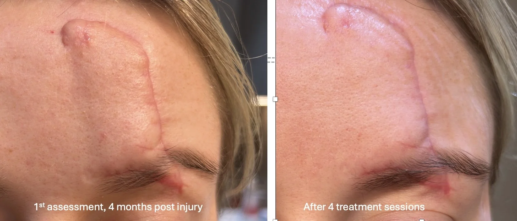 Forehead laceration: Reducing swelling and improving eyebrow symmetry