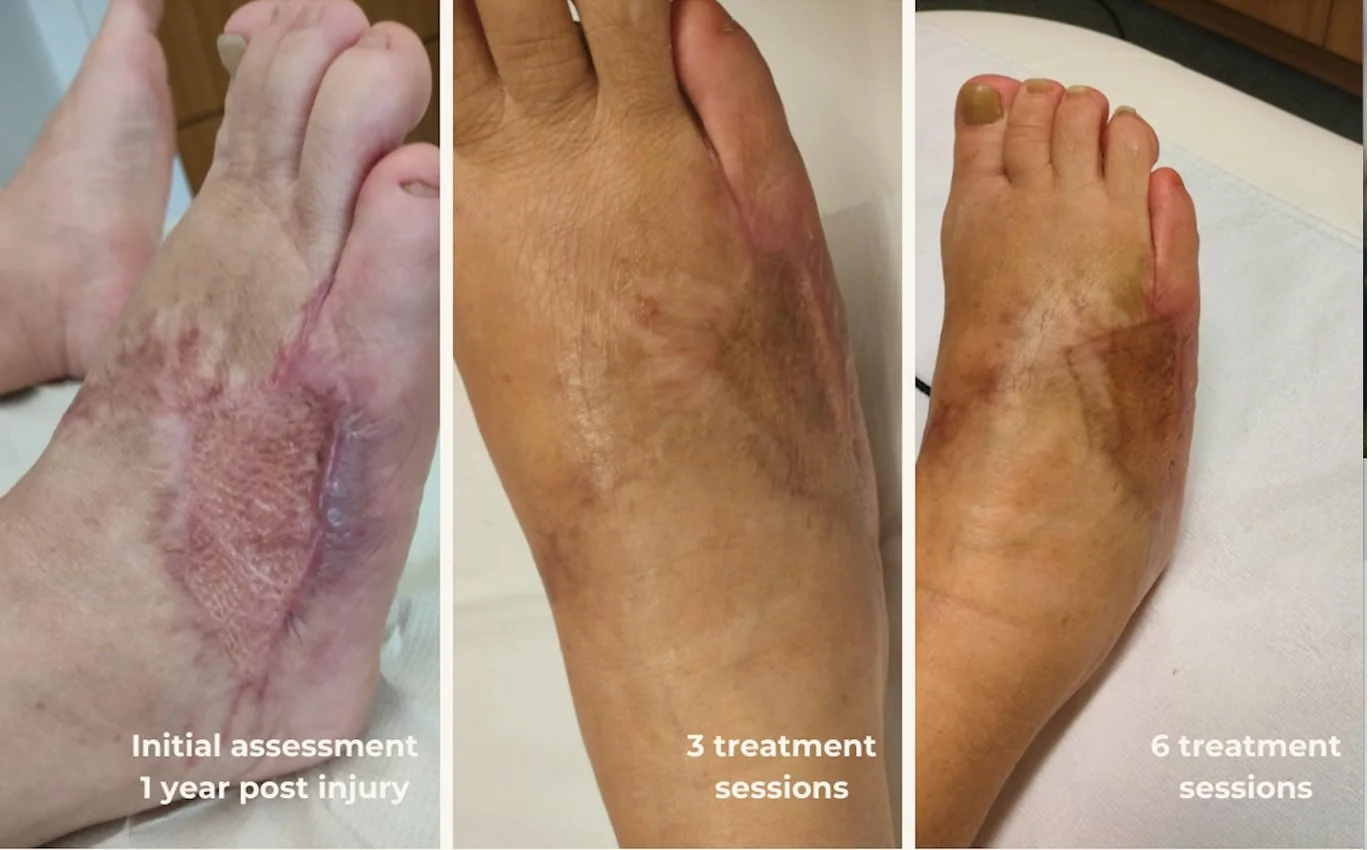 Foot degloving injury: From painful limited walking to 10,000 steps a day