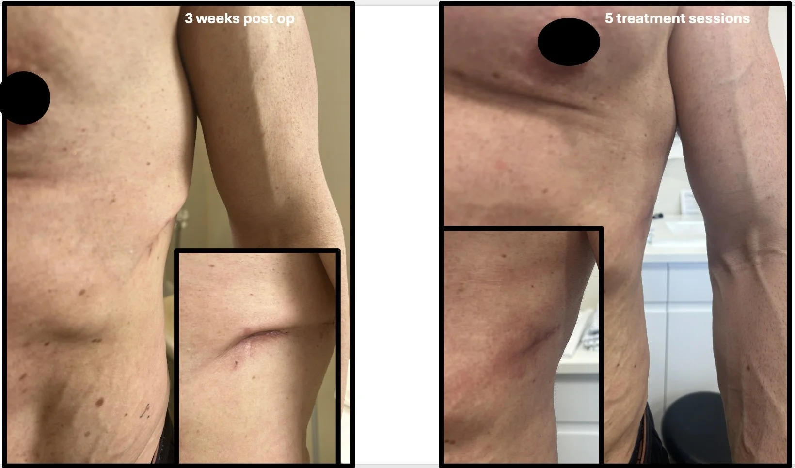 Chest surgery: Improving scar adherence and tissue contour
