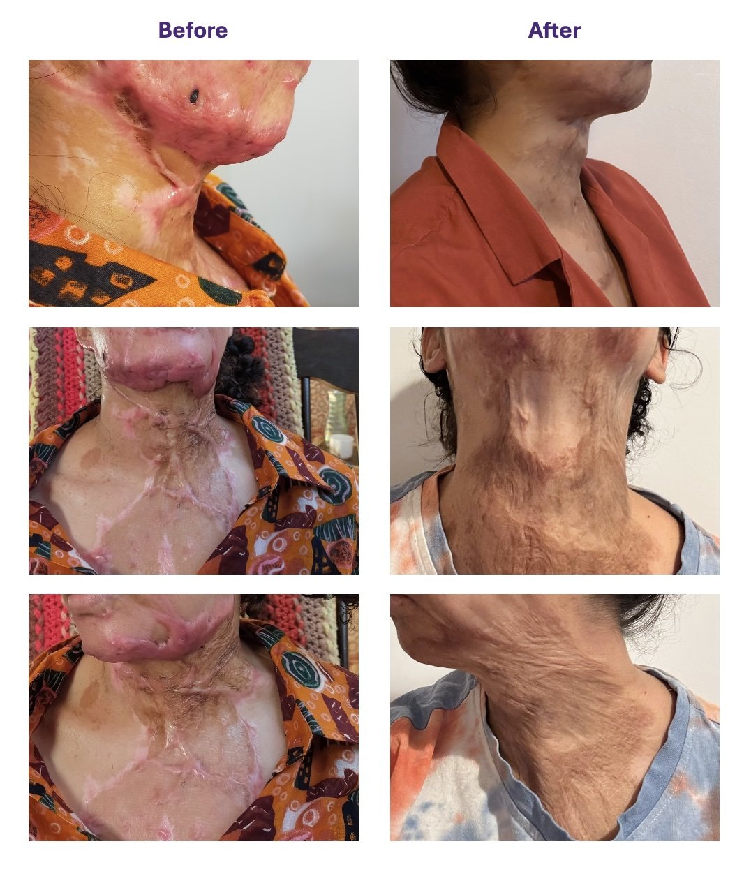 Face and neck burn scars: Improving movement, comfort and appearance