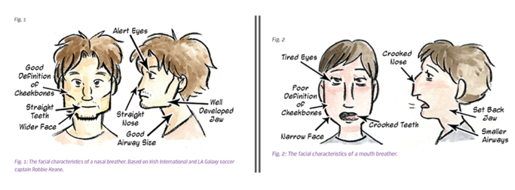 The Incredible Melting Face: How Mouth Breathing Reshapes Facial Development