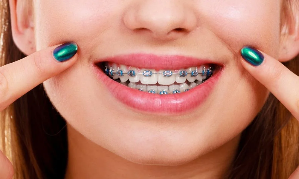 Why Orthodontic Success Begins with the Tongue