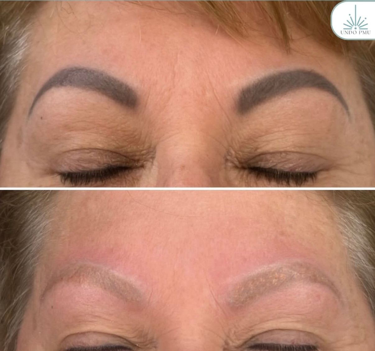 Before and after images of eyebrow tattoo removal, showing dark, thick eyebrows in the first image and significantly faded eyebrows in the second image.