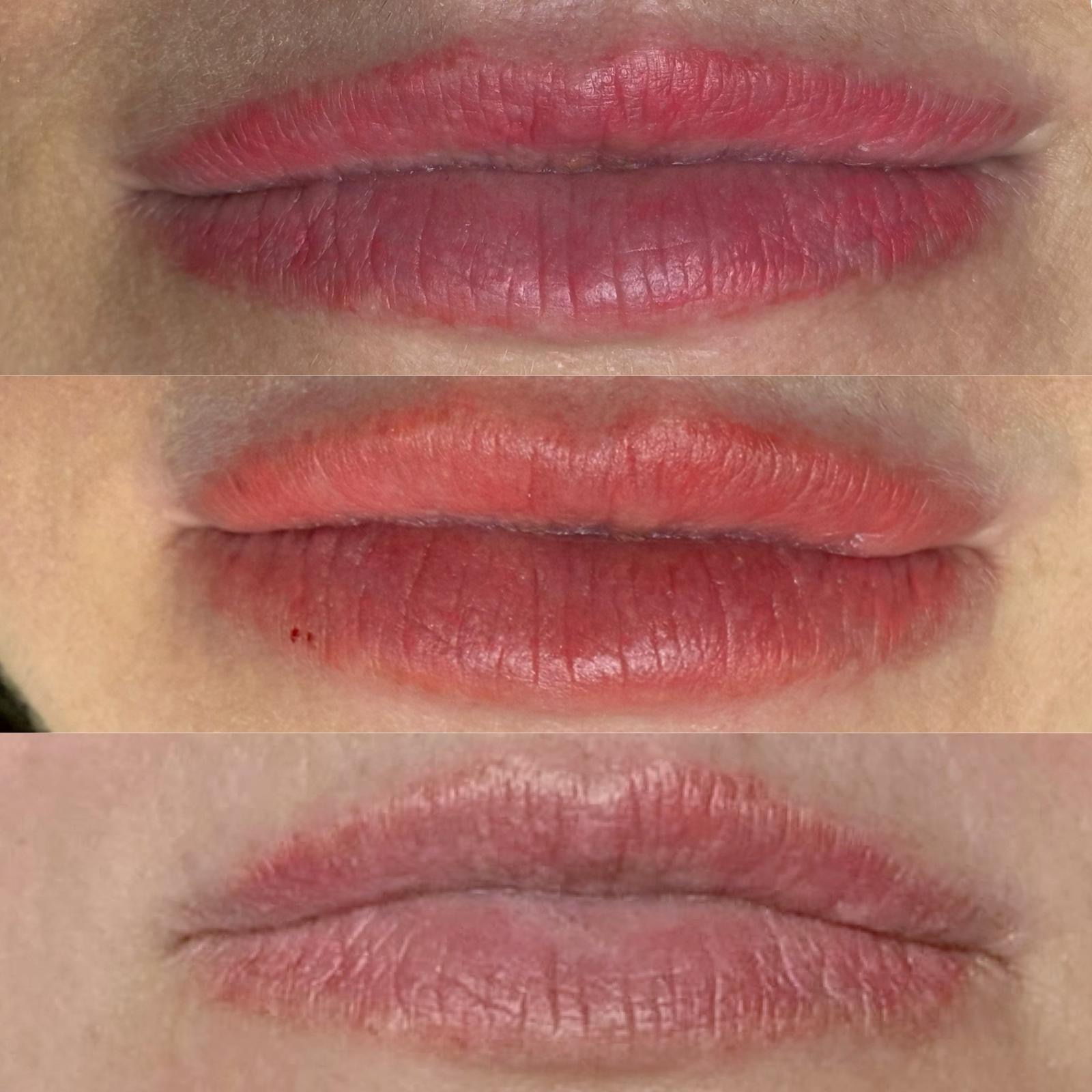 Before and After Laser Removal Permanent Makeup Lips