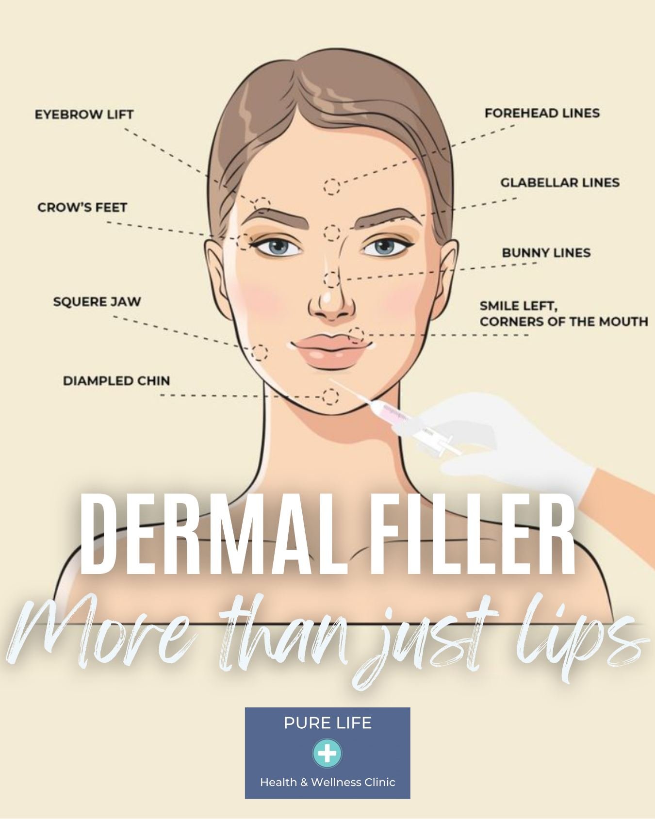 Think filler is just for lips? Think again. 💉 ✨

Dermal fillers can restore volume, smooth lines, and enhance natural contours in areas like:
✔️ Cheeks
✔️ Jawline
✔️ Under-eyes (tear troughs)
✔️ Nasolabial folds
✔️ Temples

It&rsquo;s all about bala
