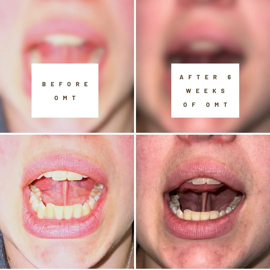 A suction hold before myofunctional therapy vs a suction hold after 6 weeks of myofunctional therapy. 
Why does this matter? You can see so much more posterior engagement of the muscle after a few sessions of therapy, so much more toning of the muscl