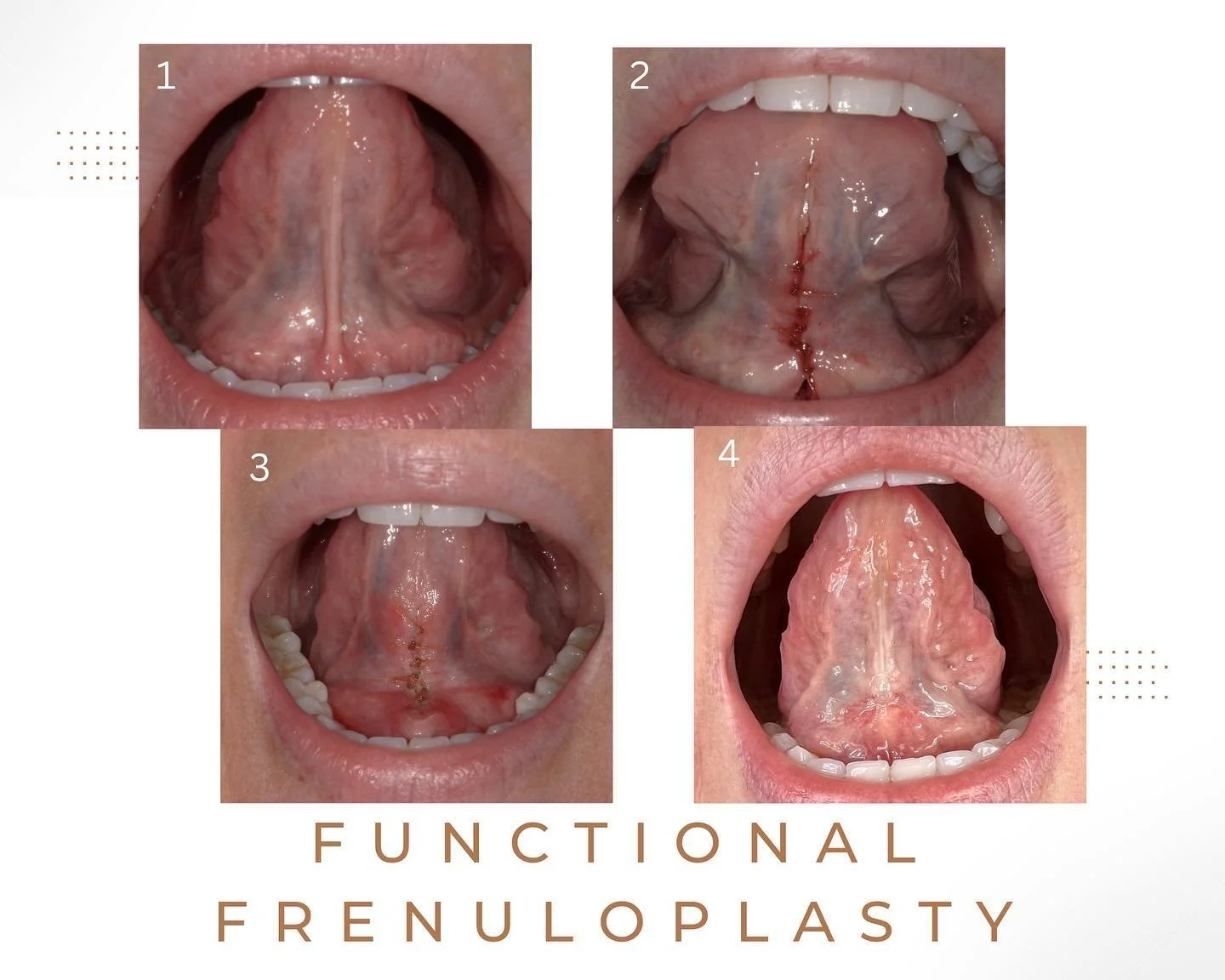 Last month I got my tongue tie released by the best @drlizzzt !! 
(Photo 1-pre op, 2-post op, 3-1 week post op, 4-4 weeks post op.)
Even with minor symptoms, I&rsquo;ve seen improvement with a number of things&hellip;
&bull;tongue fully up in my pala