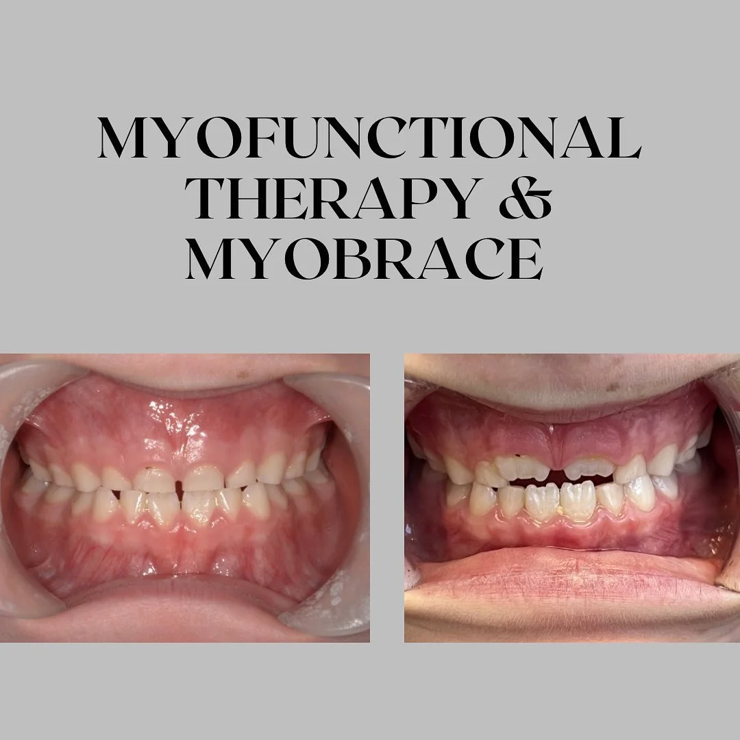 This patient is going through expansion with a removable appliance (MyoBrace) along with doing myofunctional therapy. 

In comparing these before and after photos, which were taken about 4 months apart, we can see that there is now more room for the 