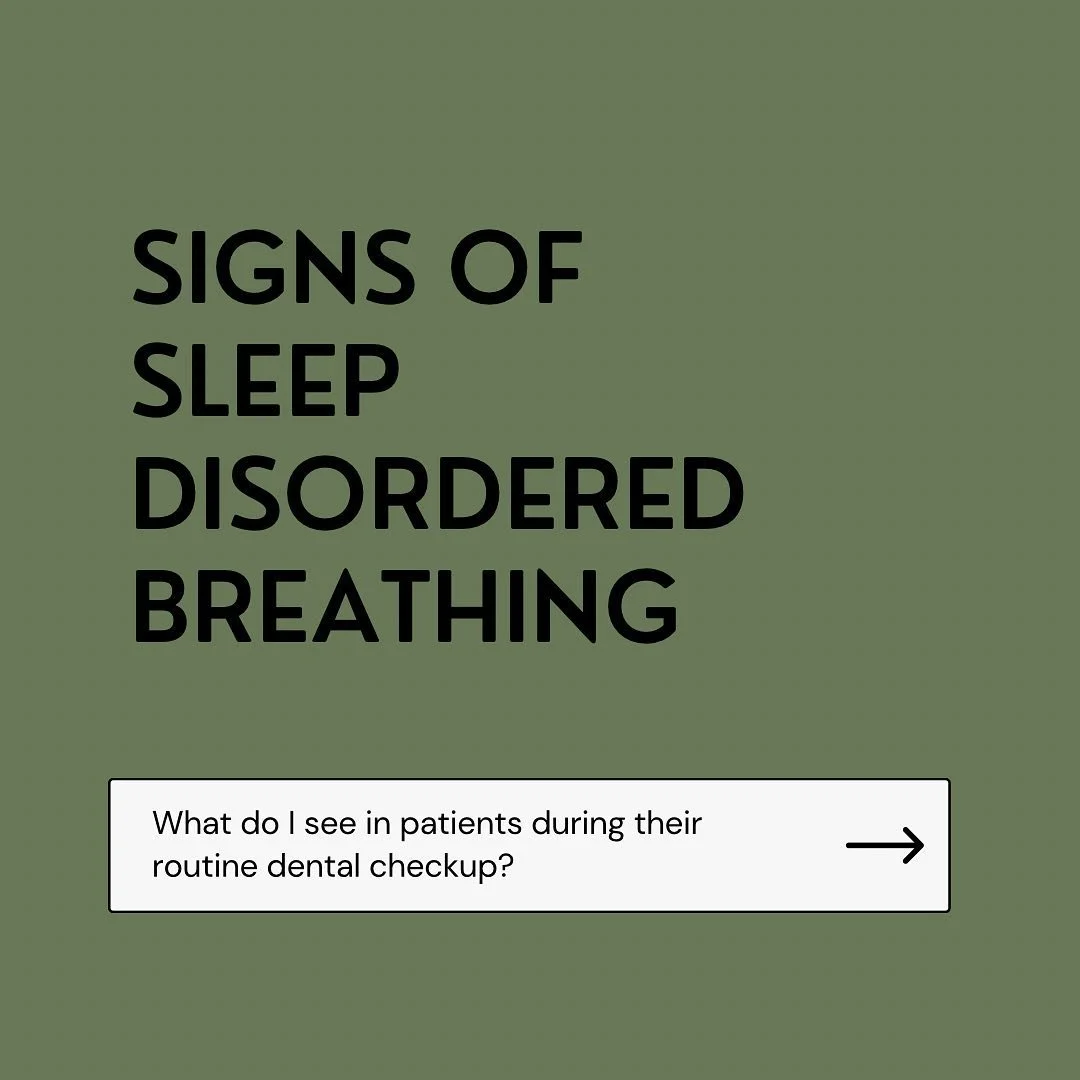 Some signs of sleep disordered breathing will manifest in the mouth. This is why, as dental professionals, we should be screening for airway issues and asking more questions to our patients. 

Some of the more common signs I see in the dental chair a