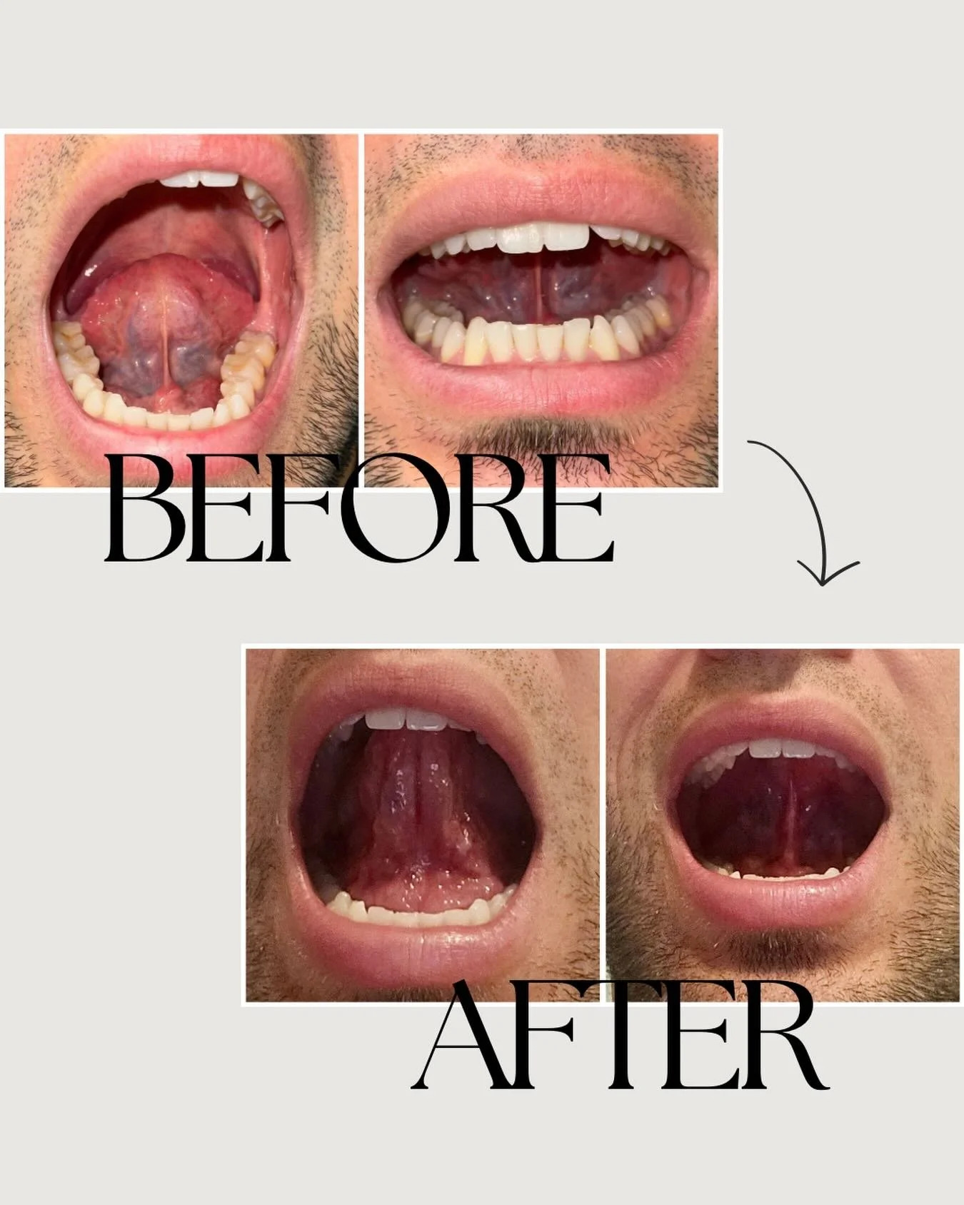 When I first met this patient, he was concerned about his sleep quality. He had been recently diagnosed with mild-moderate sleep apnea and at 36 years old wanted options other than a CPAP or oral appliance. We have gone through 10 sessions of myofunc