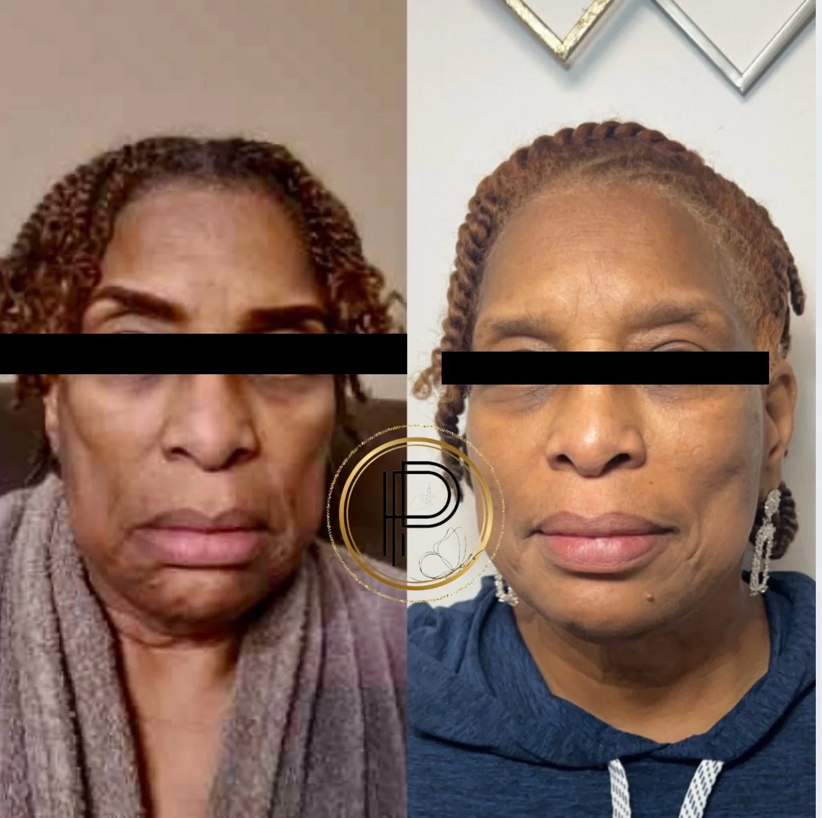 Facial Balancing.. client concern : loss of volume /hollow areas, sagging of lower face. Results were achieved using Dermal filler to restore volume in mid face and buccal area. *Before photo was provided by client and taken at her home. After photo