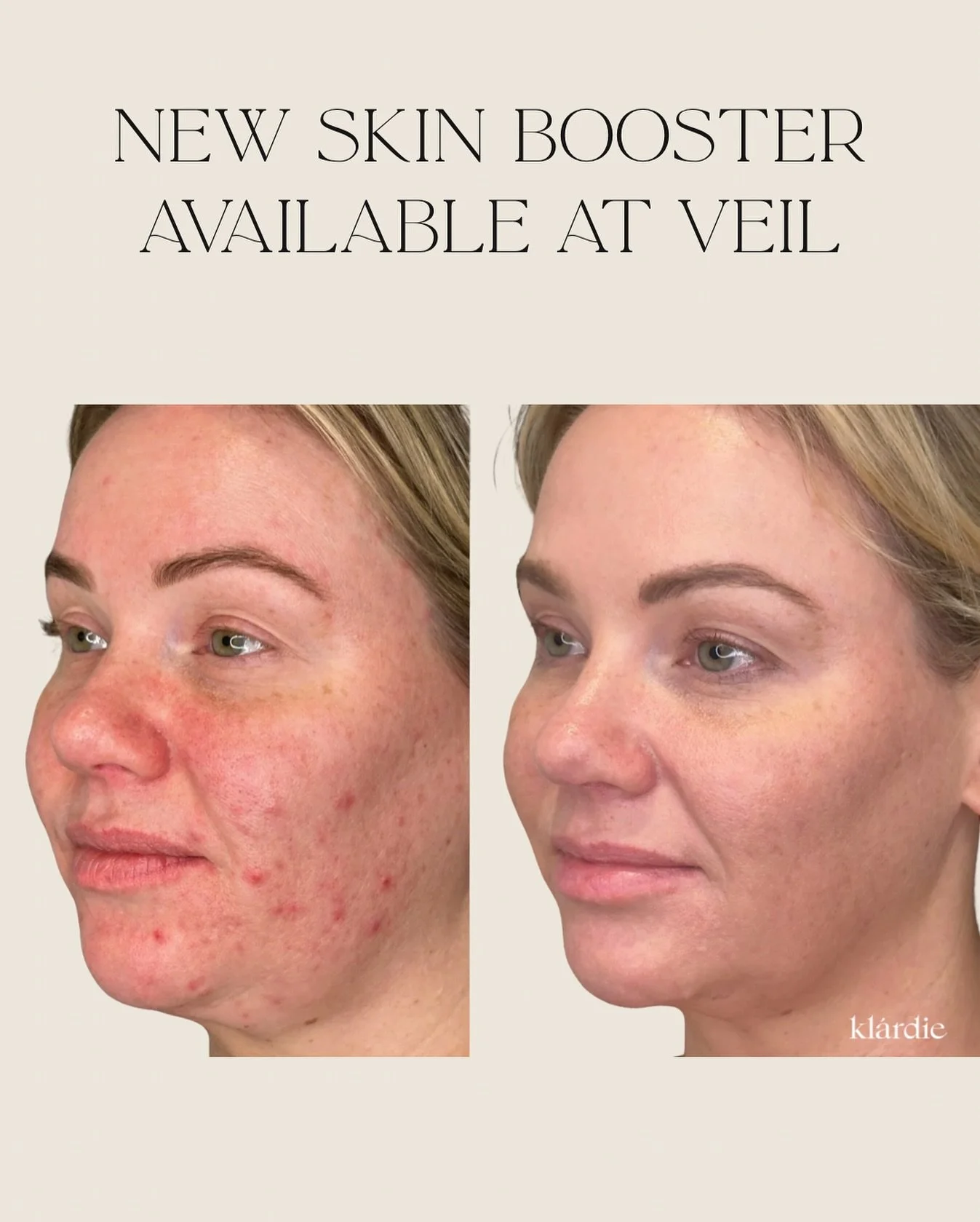 Introducing Klardie Skin Booster to be used with Micro-needling or as an add on to your laser treatment to boost results! 

I absolutely adore Korean bio science so couldn&rsquo;t resist this product. 

Think glass skin glow, and treating pigment as 