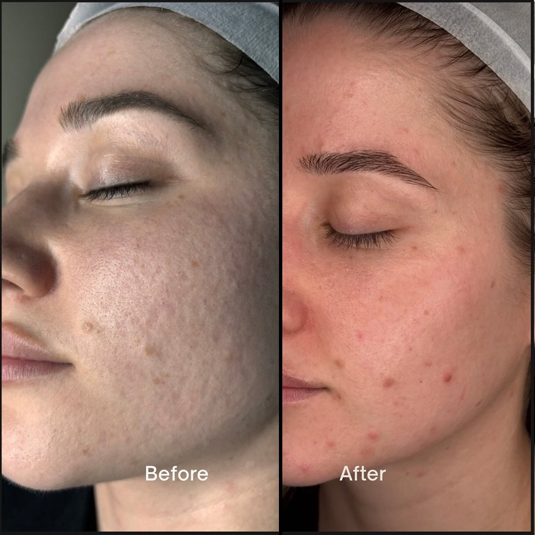 ✨Skin texture correction @ Veil_aesthetics✨

Our focus was to smooth out the wavy texture to skin caused by old acne.

Client had completed her course of treatments and we are delighted with the results. 

We done a layered same day treatment includi