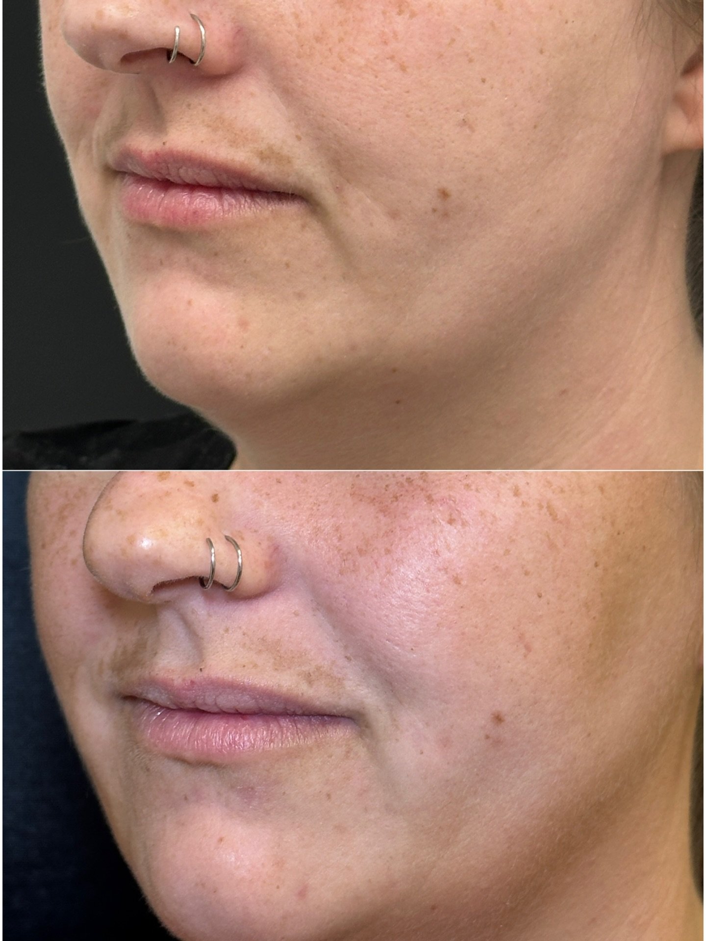 ✨ Okay, I&rsquo;ll admit it&hellip; I&rsquo;m hyper-focused on Klardie right now &mdash; but honestly, it&rsquo;s my new obsession!

Klardie is a Korean skin booster that&rsquo;s micro-needled into the skin to target texture, pores, and overall glow 