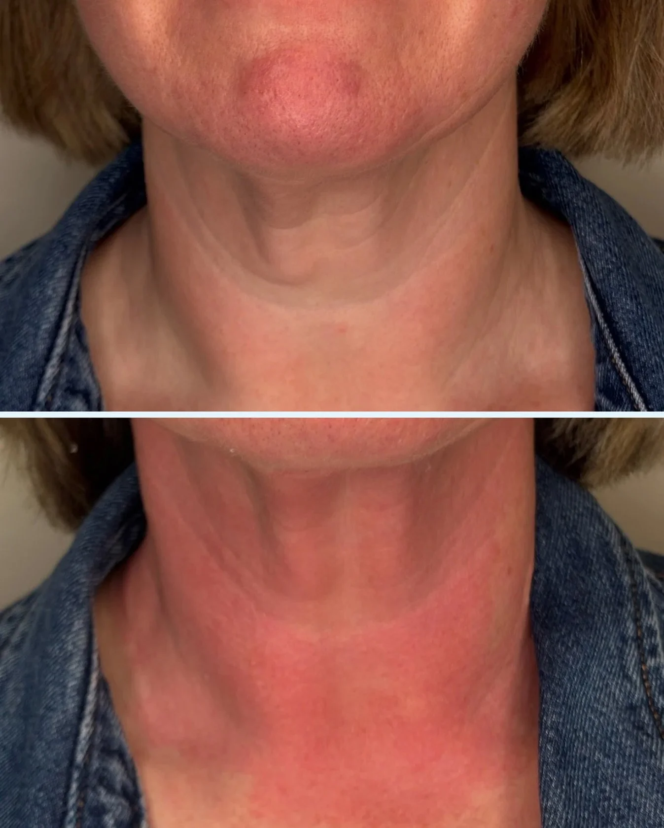 ✨ The neck &mdash; one of the most important (yet so often forgotten!) areas in skin health.

My client wanted a little extra love here: a touch of tightening, some lifting, and help softening those fine lines.
And if you know me&hellip; you know I a