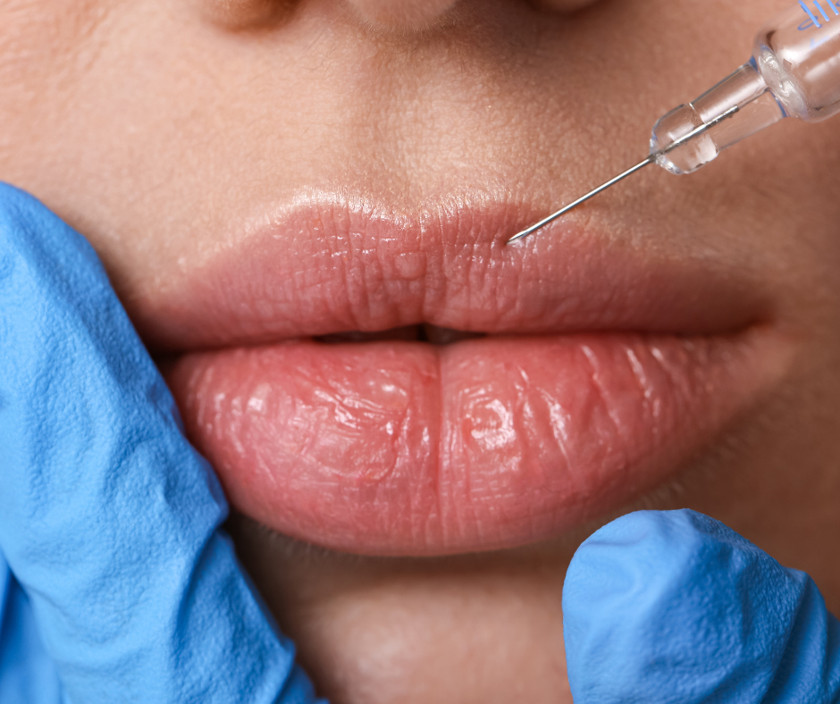 Close-up of a person's lips being prepared for an injection with a syringe, with a medical gloved hand stabilizing the lip.