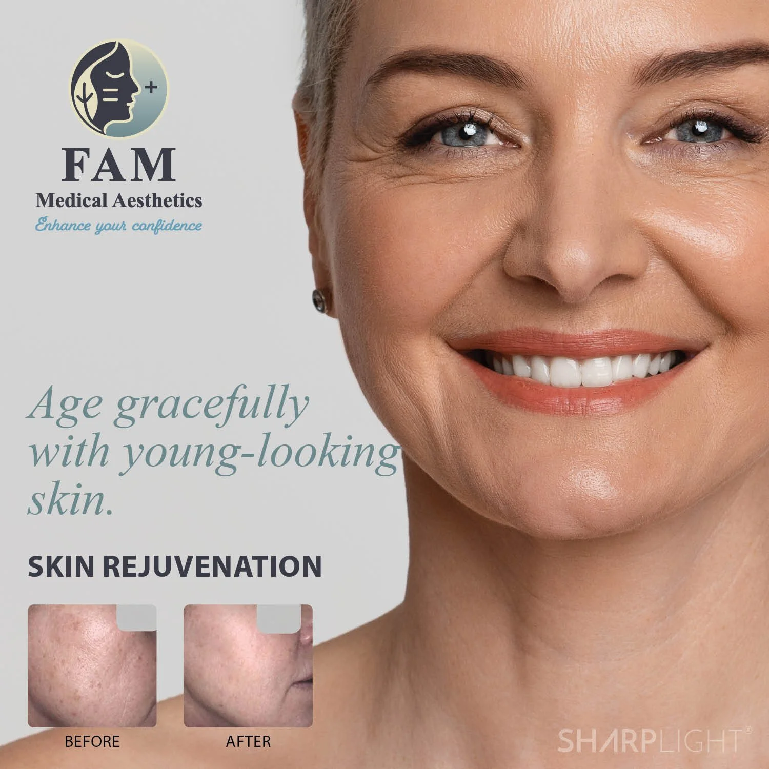 Why You Should Consider Microneedling: Benefits, Myths, and What to Anticipate