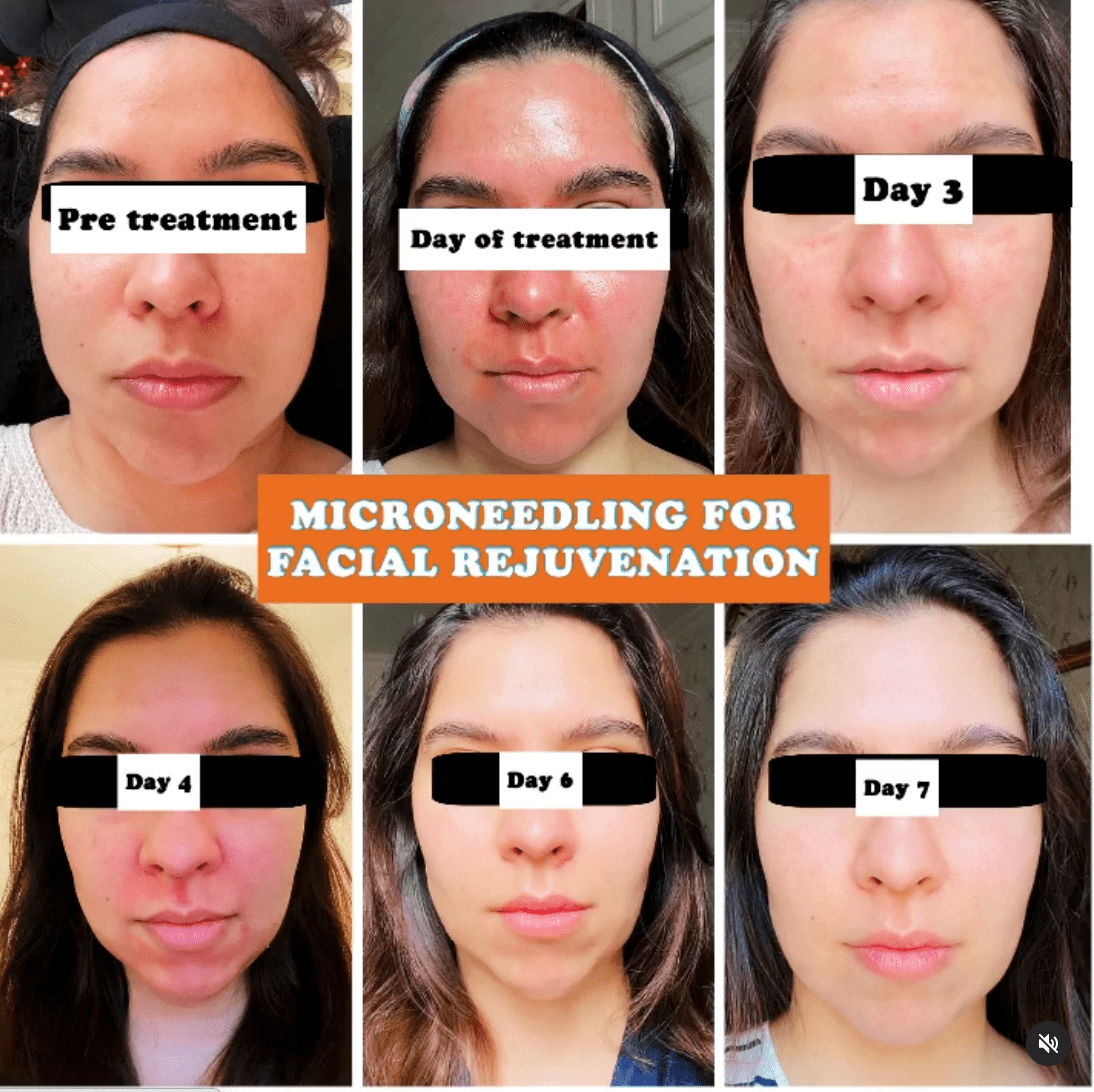 microneedling before and after