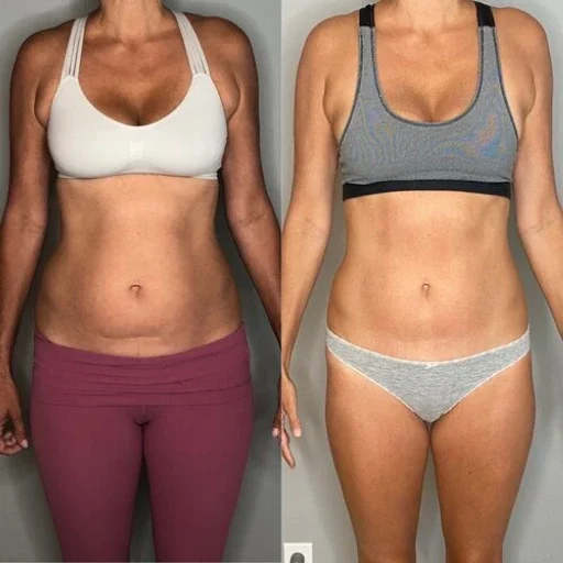 radiofrequency skin tightening before and after