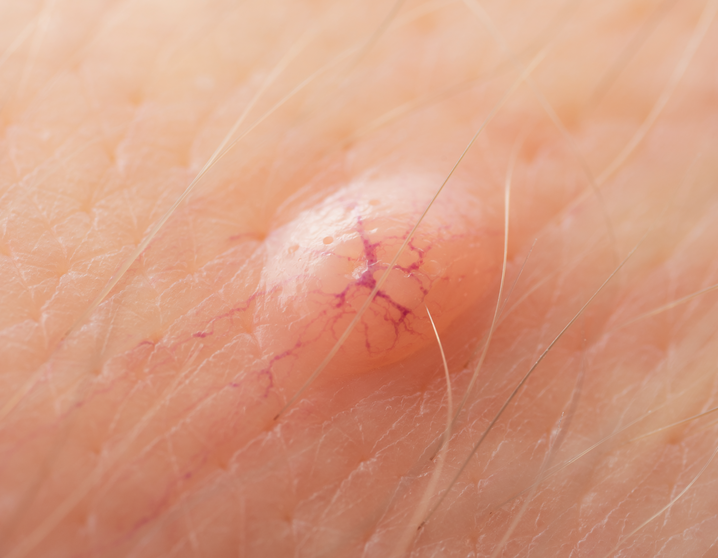 Close‑up vascular pigmentation