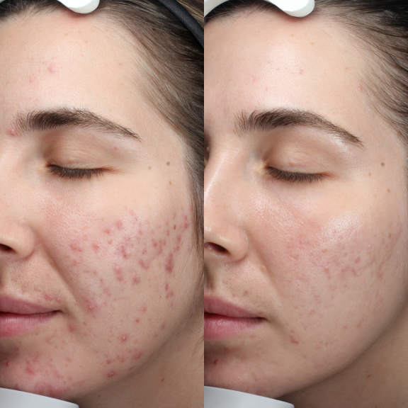 microneedling before and after