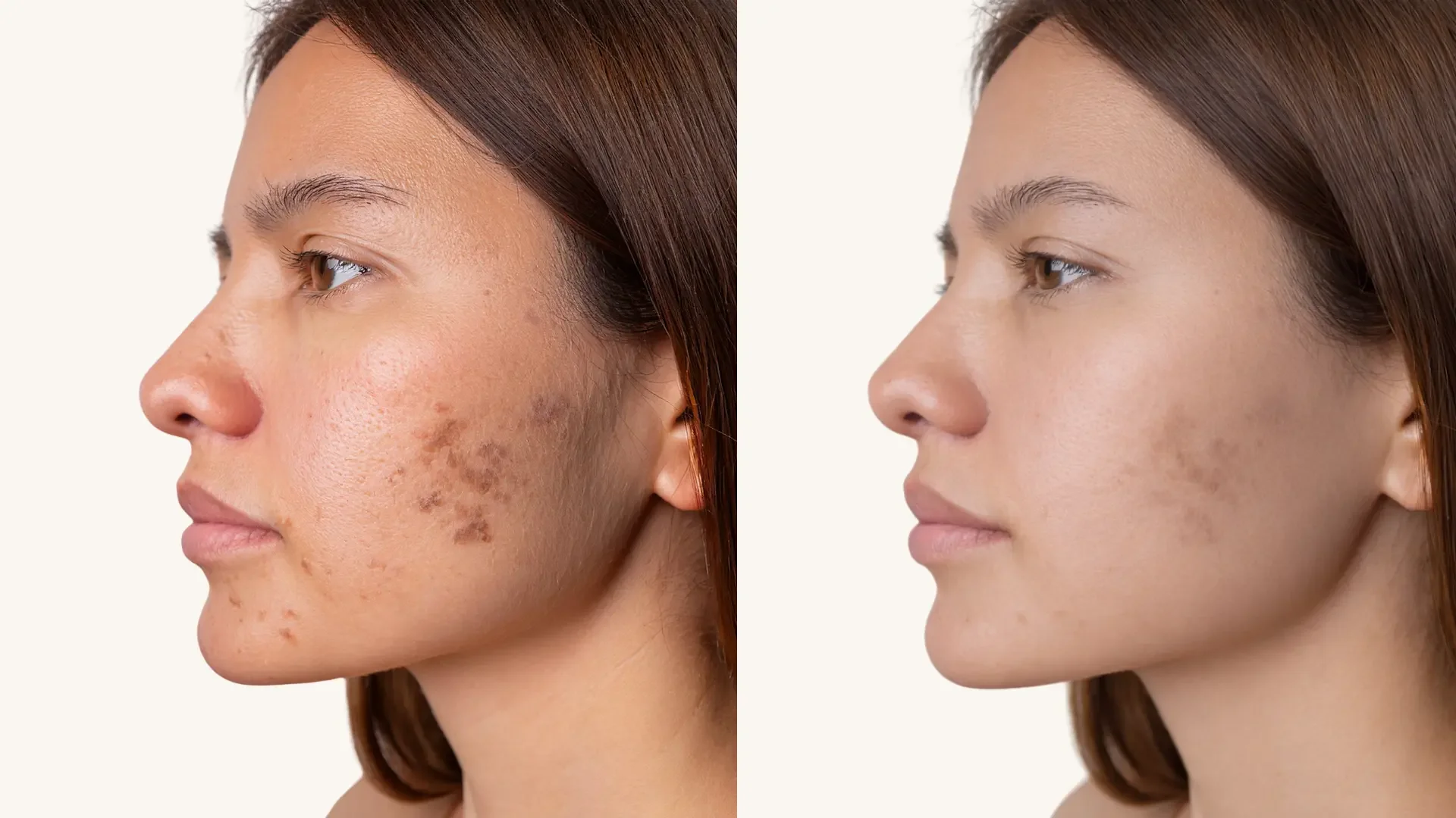 microneedling for hyperpigmentation